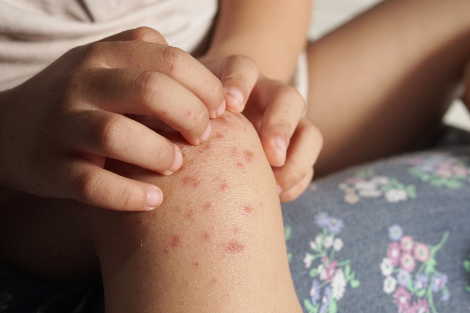 Enchentes no RS: contaminação de água e alimentos aumentam os riscos da população contrair enterovírus Enchentes no RS: contaminação de água e alimentos aumentam os riscos da população contrair enterovírus